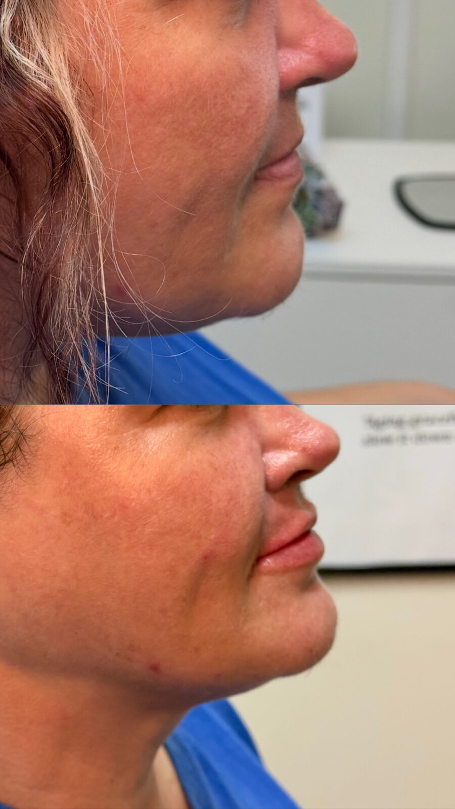 Forehead lines before/after – smoother after 2 weeks